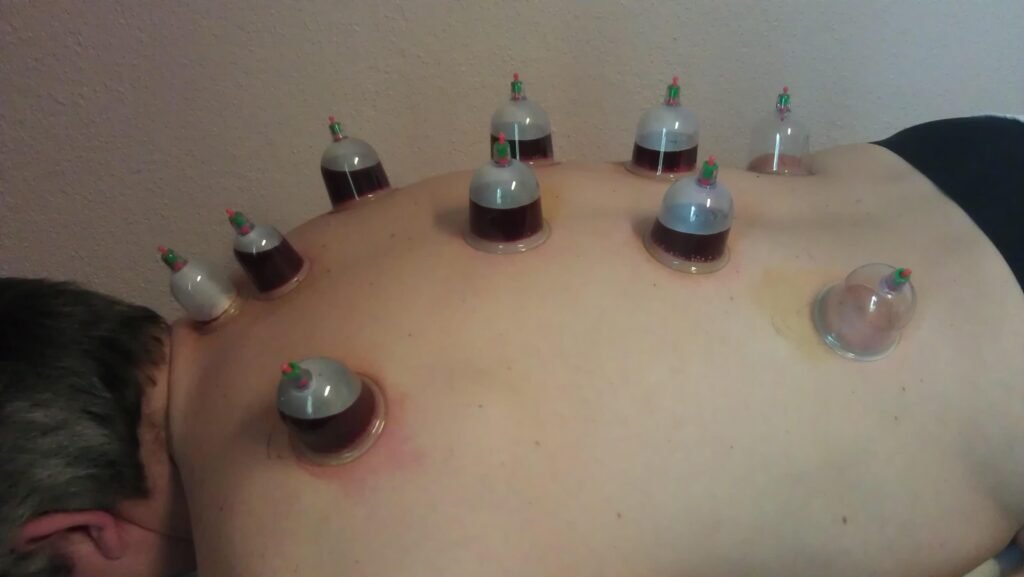 Home cupping 1