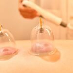 patient experiencing cupping therapy