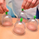 patient experiencing cupping therapy